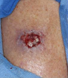 Lower Leg Wound Treatment At Scars Center