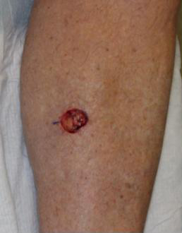 2.0 cm Excision Defect of BCC of Lower Leg