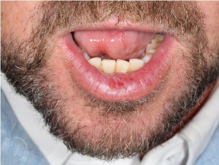 Dysplasia of Lower Lip - Skin Cancer and Reconstructive 