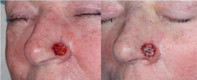 Nasal-Ala-Defect-Bilevel-Skin-Graft-Orange-County-Cancer1