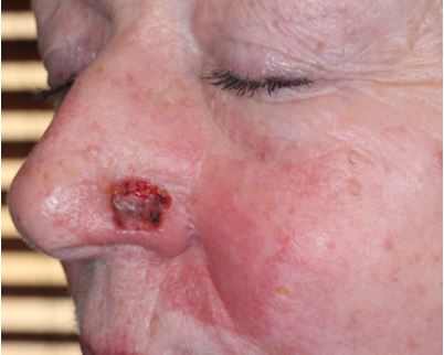 Nasal-Ala-Defect-Bilevel-Skin-Graft-Orange-County-Cancer3
