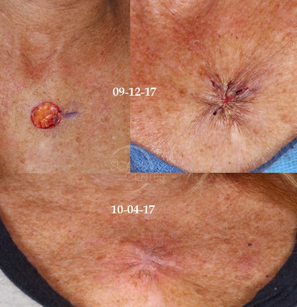 cerclage-closure-skin-cancer-Mohs-and-reconstruction-orange-county