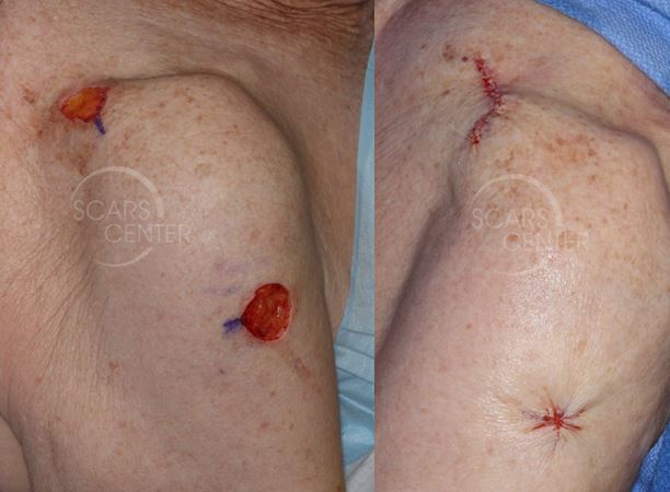 cerclage-closure-skin-cancer-Mohs-and-reconstruction-orange-county-