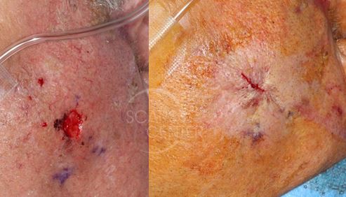 cerclage-closure-skin-cancer-Mohs-and-reconstruction-orange-county-
