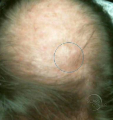 myxoid-lipoma-scalp-soft-tissue-mass-skin