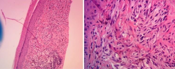 Dysplastic-nevus-melanocytic-tumor-porcine-xenograft-island-flap