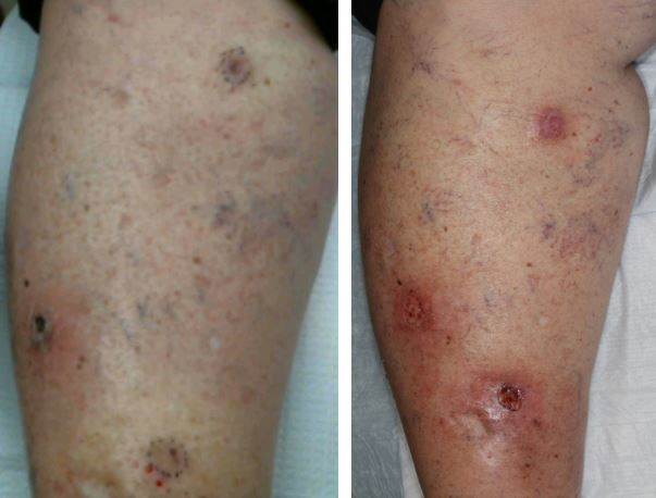 Basal-cell-carcinoma-shave-excision-skin-cancer-orange-county-shave-excision-dermablade2