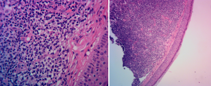 atypical-lymphoid-infiltrate-cutaneous-B-Cell-lymphoma-skin-cancer-orange-county