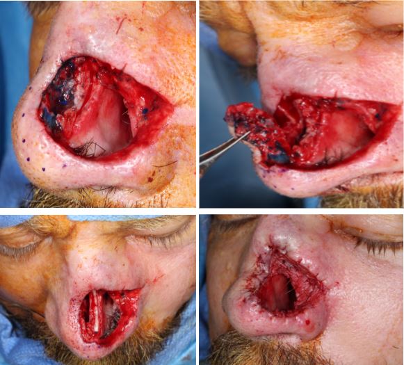 Recurrent-SCC-nose-rhinectomy-mapping-biopsy-SCARS-center-Mohs-excision-infiltrative-squamous-cell
