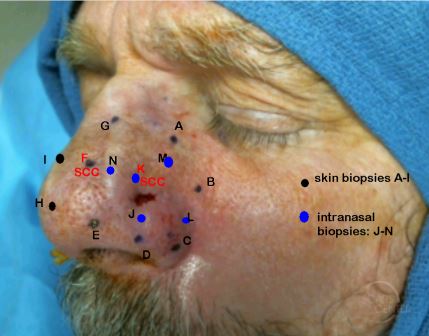 Recurrent-SCC-nose-rhinectcomy-mapping-biopsy-SCARS-center-Mohs-excision-infiltrative-squamous-cell