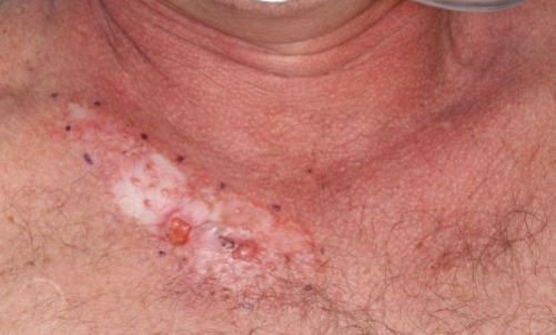 basal cell carcinoma early stages chest