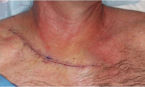 Upper-Chest-BCC-perineural-invasion-Mohs-and-closure-SCARS-center-wide-local-excision-SRT-radiotherapy-orange-county-skin-cancer
