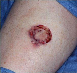 melanoma-in-situ-serial-excisions-mohs-excision-platysma-myocutaneous-flap-mapping-biopsy-orange-county-skin-cancer-dermatopathology