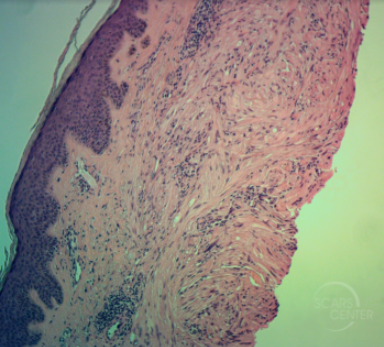 leiomyoma-complete-excision-sarcoma-leiomyosarcoma-skin-cancer-orange-county-pathoogy