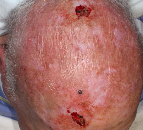 anticoagulant-use-in-cutaneous-surgery-scalp-squamous-cell-carcinoma-Mohs-and-reconstruction