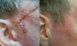 recurrent-bowens-disease-squamous-cell-carcinoma-topical-chemotherapy