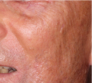 scleromyxedema-cutaneous-lesions-dermatopathology-spindle-cell-basal-cell-carcinoma