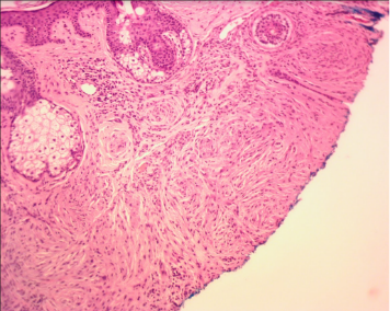 scleromyxedema-cutaneous-lesions-dermatopathology-spindle-cell-basal-cell-carcinoma