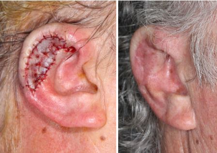 subtotal-ear-reconstruction-alloplast-tpf-flap-skin-cancer-orange-county