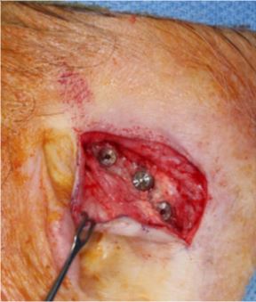 total-ear-reconstruction-with-osseointegrated-prosthesis-skin cancer-orange-county