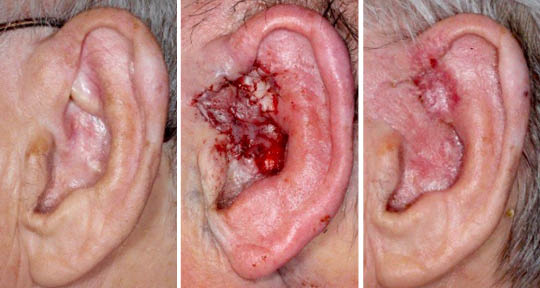 squamous cell carcinoma ear