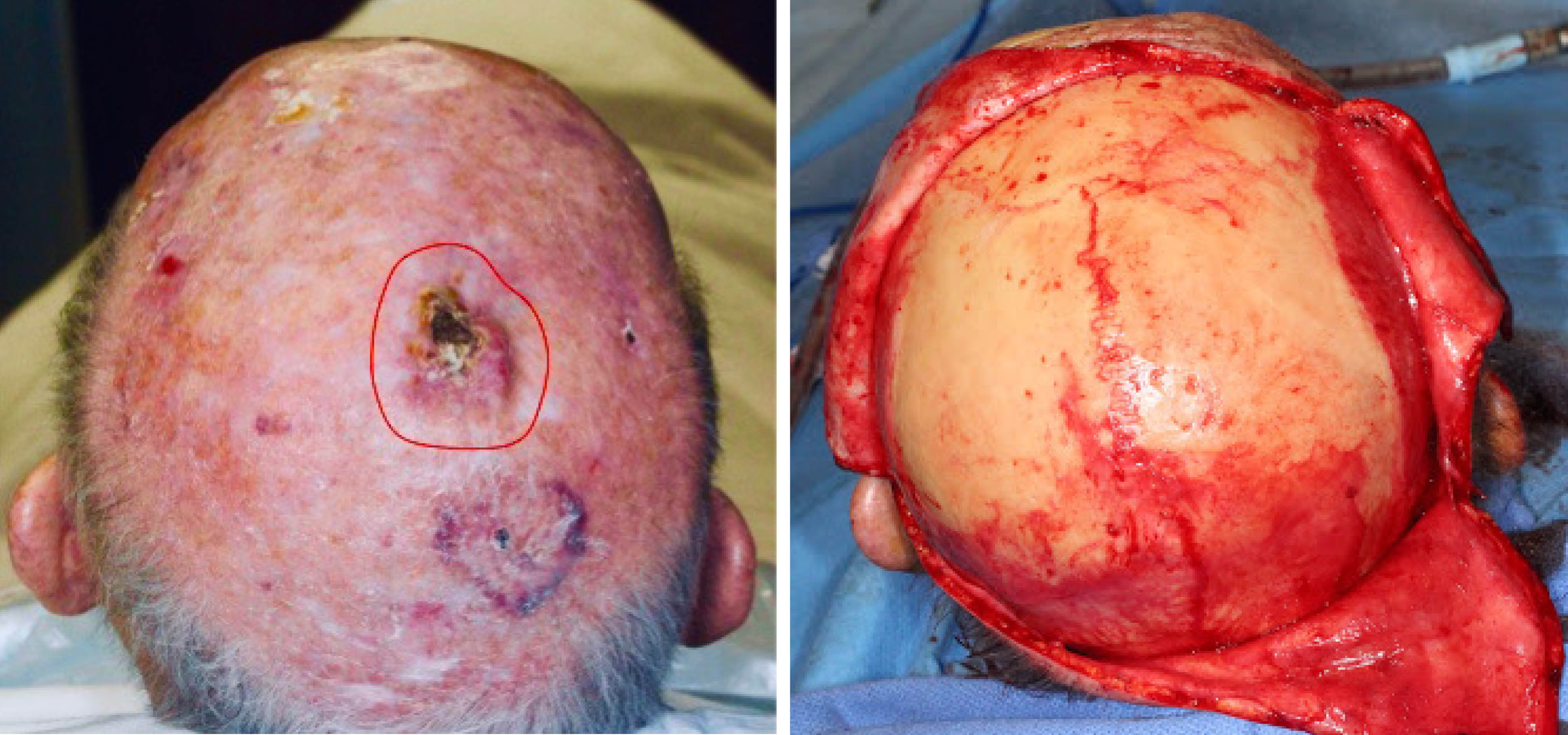 sarcoma cancer on the scalp