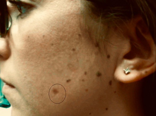 compound nevus with mild atypia