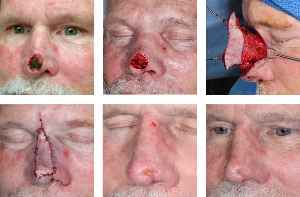 infiltrative basal cell carcinoma