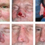 Nasal Open Wound Complication