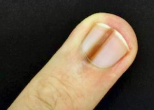 Evaluation of Longitudinal Melanonychia - Skin Cancer and