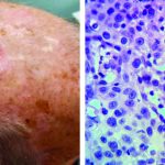 A Case of Mistaken Identity: Porocarcinoma of the Scalp Initially Diagnosed as Basal Cell Carcinoma