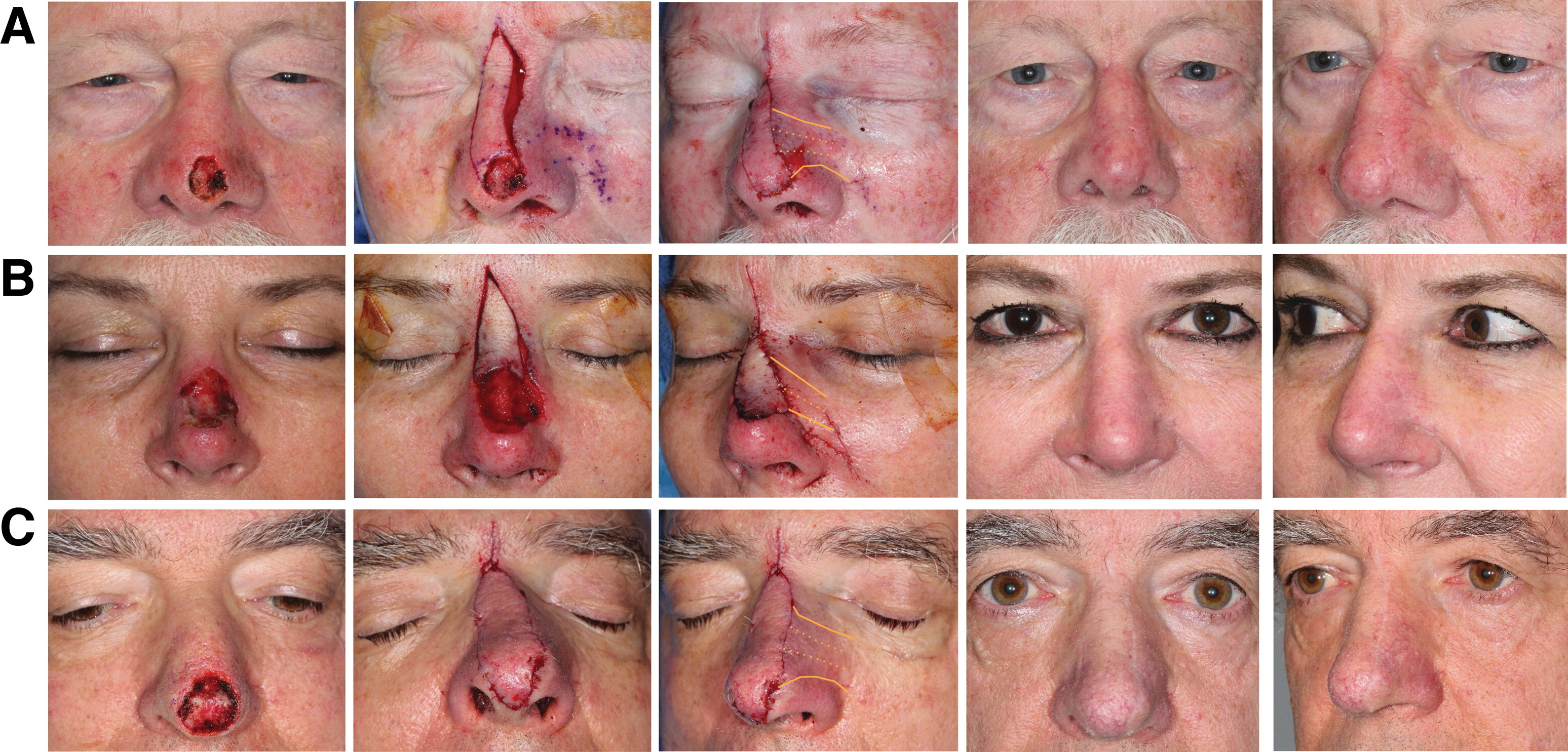 Superior Extended Nasal Myocutaneous Island Flap: An Alternative to Forehead Flap Reconstruction of the Nose