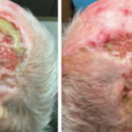 Management of Non-Healing Lesion