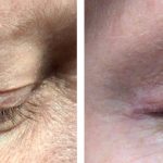 Managing Eyelid Skin Cancer