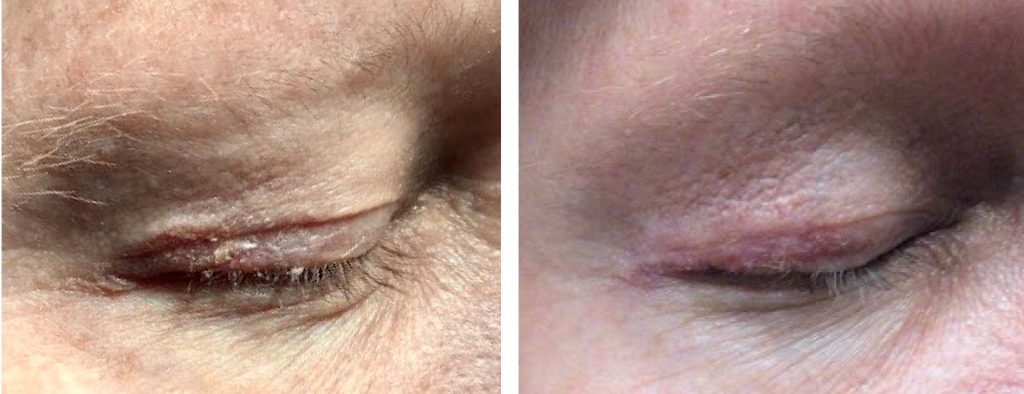 melanoma on eyelid