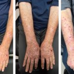 Augmenting Efficacy of Topical 5-FU for Actinic Keratoses and Skin Cancer
