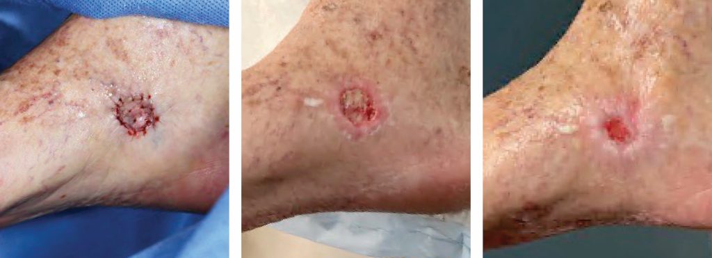 Calayan Skin Clinic - Lucena City - How to get rid of SCARS on LEGS:  Natural and Medical remedies Prompt Treatment Proper wound care can  minimize the appearance of minor scars, such