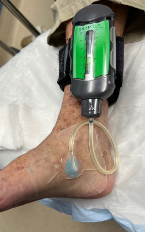 wound vac