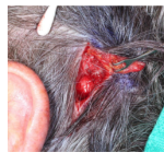 Subcutaneous Intravascular Pyogenic Granuloma of the Scalp of a POEMS Syndrome Patient