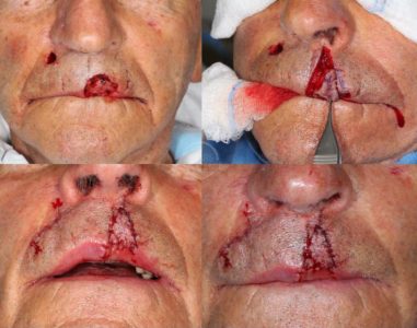 BCC-Left-Upper-Lip-Orange-County-Skin-Cancer-Mohs-Reconstruction