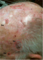 Treatment for Multiple Skin Cancer Patients