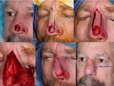 Recurrent-SCC-nose-rhinectcomy-mapping-biopsy-SCARS-center-Mohs-excision-infiltrative-squamous-cell