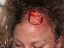 Skin-Cancer-And-Reconstructive-Surgery-Center-Skin-Cancer-Specialists-Intraoperative-Photos-WM-1