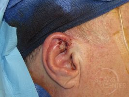 Skin-Cancer-And-Reconstructive-Surgery-Center-Skin-Cancer-Specialists-Intraoperative-Photos-WM-2