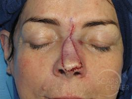 Skin-Cancer-And-Reconstructive-Surgery-Center-Skin-Cancer-Specialists-Intraoperative-Photos-WM-2