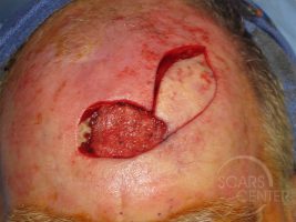 Skin-Cancer-And-Reconstructive-Surgery-Center-Skin-Cancer-Specialists-Intraoperative-Photos-WM-2