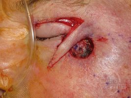 Skin-Cancer-And-Reconstructive-Surgery-Center-Skin-Cancer-Specialists-Intraoperative-Photos-WM-4jpg