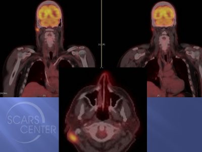 Skin-Cancer-And-Reconstructive-Surgery-Foundation-Scalp-SCC-Metastasis-to-neck-CT-PET-scan