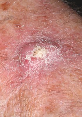 Squamous Cell Carcinoma Posts