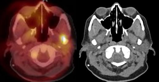 adnexal-squamous-cell-carcinoma-parotid-Mohs-and-reconstruction2